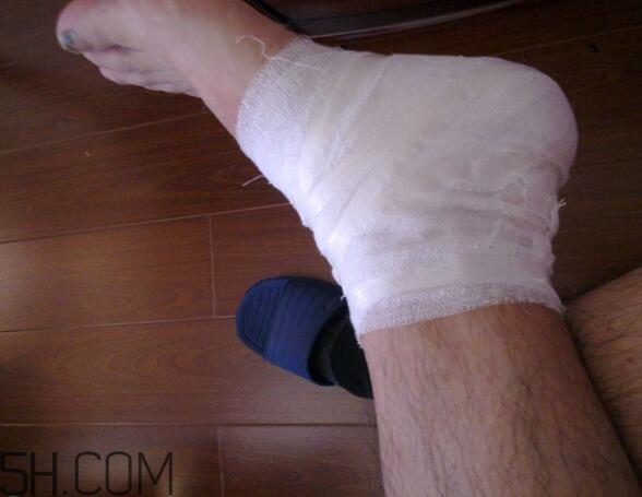 運(yùn)動(dòng)損傷是怎么造成的？怎么預(yù)防出現(xiàn)運(yùn)動(dòng)損傷？