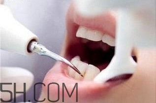 洗牙對牙齒好嗎？洗牙的6大誤區(qū)