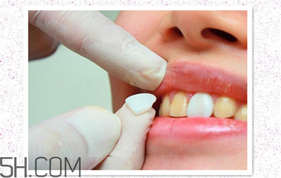 超聲波洗牙可以美白牙齒嗎？超聲波洗牙多少錢一次？