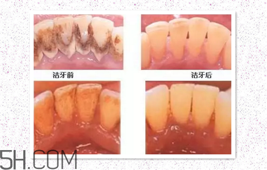 超聲波洗牙可以美白牙齒嗎？超聲波洗牙多少錢一次？