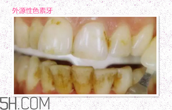 超聲波洗牙可以美白牙齒嗎？超聲波洗牙多少錢一次？