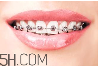 補牙需要帶牙套嗎？補牙后要裝牙套多少錢？