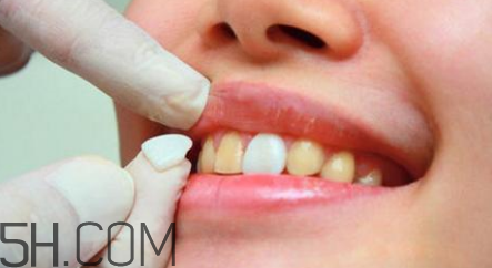 烤瓷牙取下來還能用嗎？瓷貼面美白對(duì)牙齒有損害嗎？