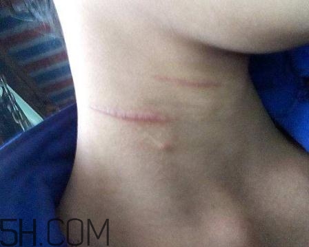 密麗除疤膏怎么用？密麗除疤膏什么時(shí)候用？