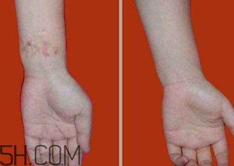 密麗除疤膏效果怎么樣？密麗除疤膏效果對比照