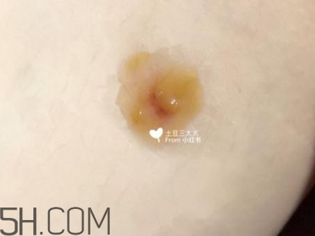 美寶濕潤(rùn)燒傷膏怎么樣？美寶濕潤(rùn)燒傷膏有用嗎？