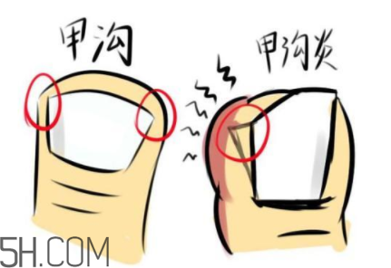 為什么容易得甲溝炎？怎么根治甲溝炎？