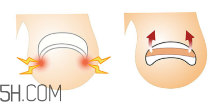 為什么容易得甲溝炎？怎么根治甲溝炎？