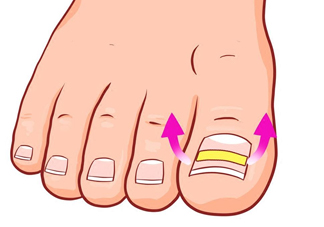 為什么容易得甲溝炎？怎么根治甲溝炎？