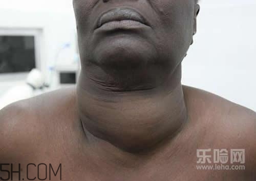 甲狀腺腫大和甲亢的區(qū)別有哪些？甲狀腺腫大適合吃什么食物？