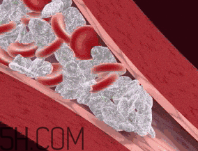 血栓究竟有多危險(xiǎn)？任何年齡都有可能得血栓