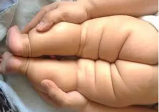 寶寶腿紋不對(duì)稱是怎么回事？嬰幼兒的生長(zhǎng)發(fā)育標(biāo)準(zhǔn)是怎樣的？