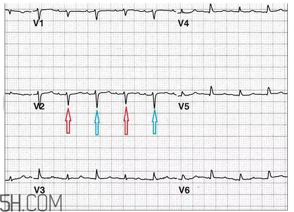 心電圖怎么看？6種常見(jiàn)心電圖異常情況