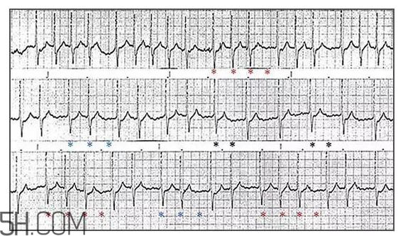 心電圖怎么看？6種常見(jiàn)心電圖異常情況
