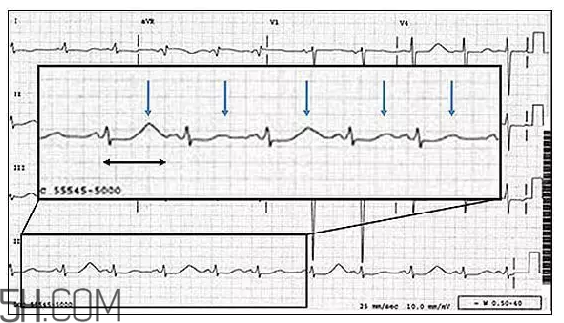 心電圖怎么看？6種常見(jiàn)心電圖異常情況