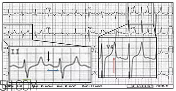 心電圖怎么看？6種常見(jiàn)心電圖異常情況
