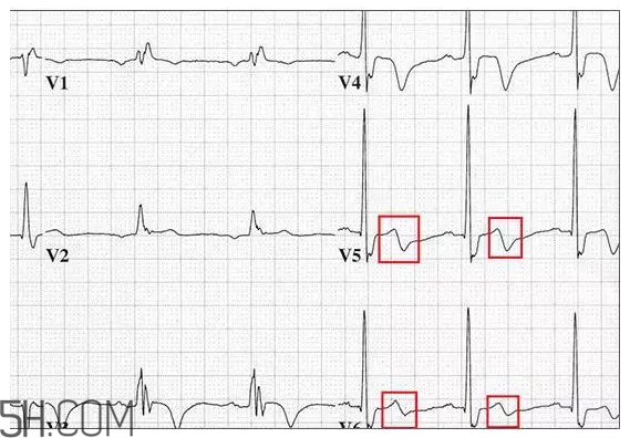 心電圖怎么看？6種常見(jiàn)心電圖異常情況