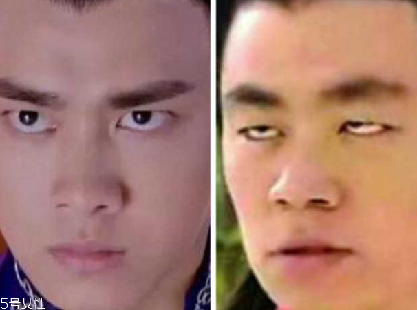 死魚(yú)眼怎么治？割雙眼皮可以治死魚(yú)眼