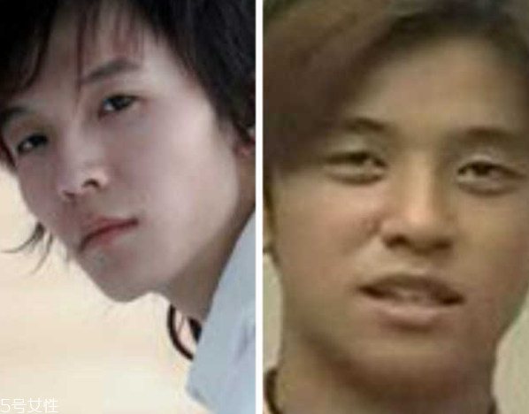 死魚(yú)眼怎么治？割雙眼皮可以治死魚(yú)眼