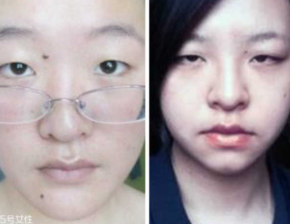 死魚(yú)眼怎么治？割雙眼皮可以治死魚(yú)眼