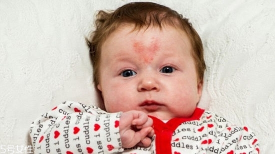 寶寶胎記會(huì)自動(dòng)消失嗎？不同胎記消失情況不同