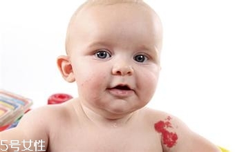 寶寶胎記會(huì)自動(dòng)消失嗎？不同胎記消失情況不同