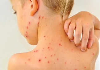 水痘有何傳播途徑？多發(fā)于春秋季