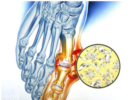 痛風可以治愈嗎？無法治愈但能控制