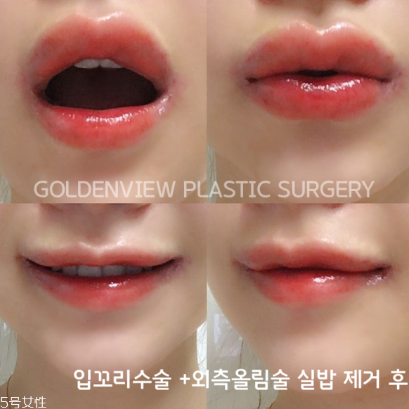 韓國人最愛整哪兒？韓國整形部位TOP4