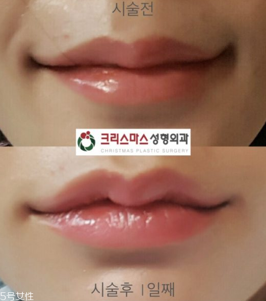 韓國人最愛整哪兒？韓國整形部位TOP4