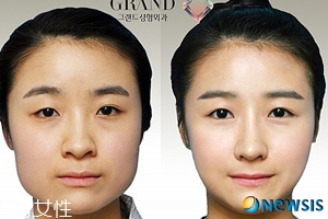 韓國人最愛整哪兒？韓國整形部位TOP4