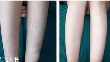 激光脫毛有哪些原理？激光脫毛后護(hù)理小貼士