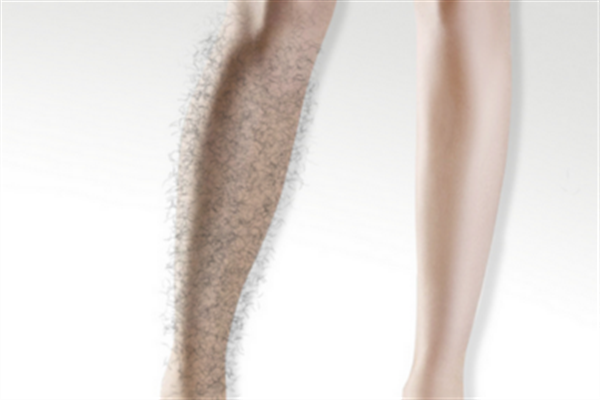 激光脫毛有哪些優(yōu)勢(shì)？激光脫毛的方式