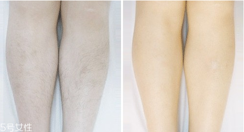 激光脫毛手術(shù)后怎么護理？激光脫毛一定要做好防曬