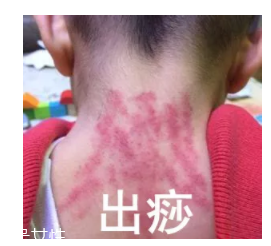 吮痧有什么療效？最溫柔的治病方法