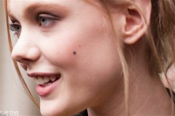 點痣的危害有哪些？激光點痣后的飲食禁忌