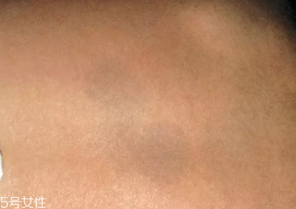 痣什么情況下會(huì)轉(zhuǎn)變?yōu)榱觯奎c(diǎn)痣不可取