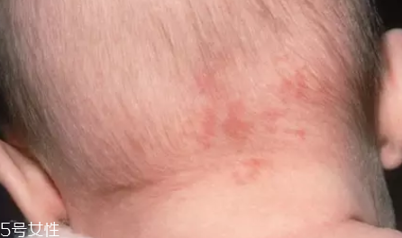 痣什么情況下會(huì)轉(zhuǎn)變?yōu)榱?？點(diǎn)痣不可取