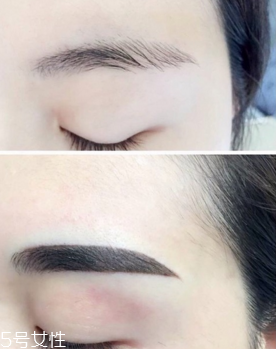 激光洗眉恢復(fù)期有疤痕怎么辦？激光洗眉毛之后正確護理方法