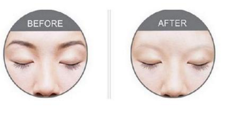 激光洗眉恢復(fù)期有疤痕怎么辦？激光洗眉毛之后正確護理方法