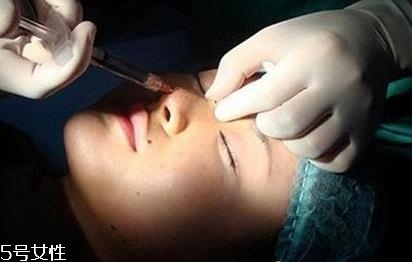 玻尿酸隆鼻多久能洗臉？玻尿酸隆鼻會越來越寬