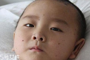 痣什么情況下會(huì)轉(zhuǎn)變?yōu)榱?？點(diǎn)痣不可取