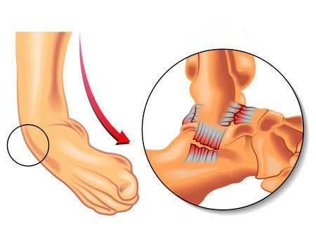 崴腳了怎么辦？緩解疼痛6大招