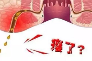 肛瘺非手術(shù)治療才可以嗎？手術(shù)是治療的關(guān)鍵途徑