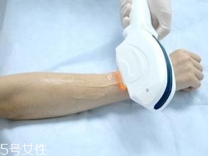 激光脫毛需要幾次？激光脫毛并不是終身有效的