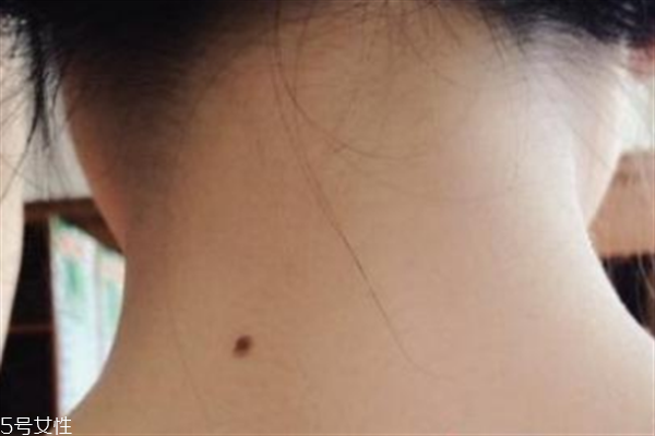 脖子后面有痣好嗎？激光冷凍祛痣易導致癌變