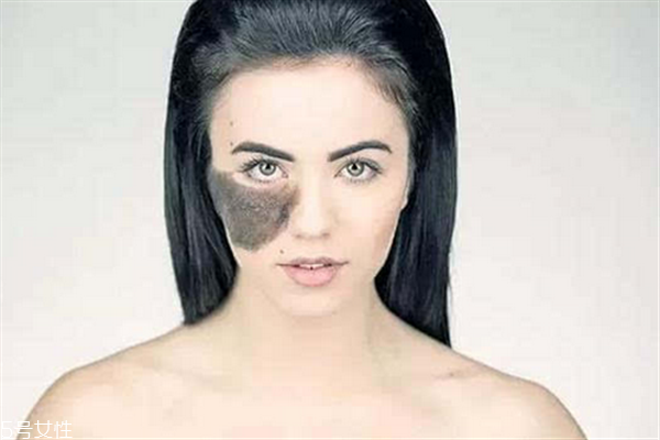 胎記長在哪里有福氣？胎記的本質(zhì)是色素沉著