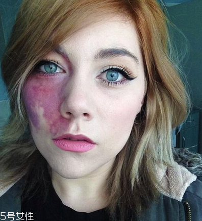 胎記長在哪里有福氣？胎記的本質(zhì)是色素沉著