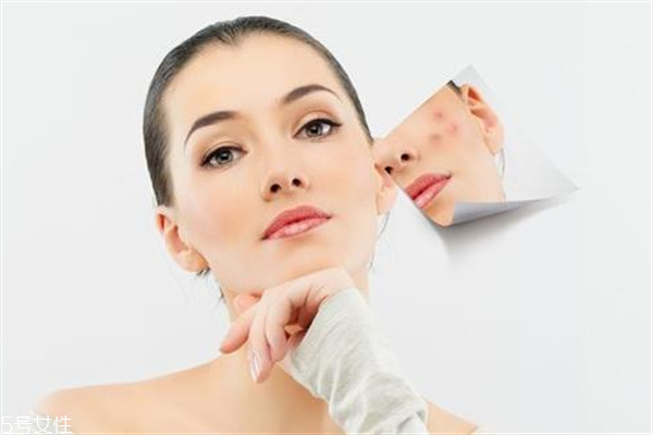 去胎記要多少錢？胎記去除后要做好護(hù)理