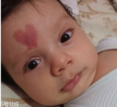 去胎記要多少錢？胎記去除后要做好護理